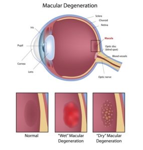 Macular Dengeration Birmingham