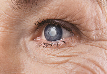 Vision After Cataract Surgery, Elmquist Eye Group