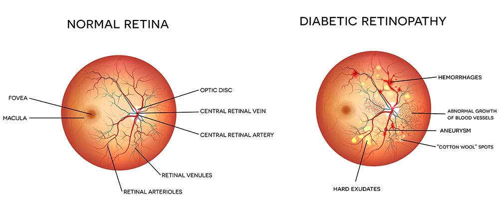 Amsler Grid Test for Retinal Conditions, When to See a Doctor