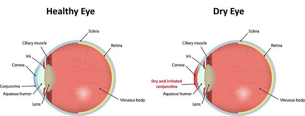 Chart Showing a Healthy Eye Compared to One With Dry Eyes