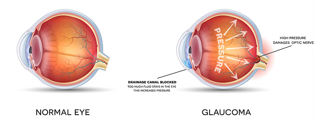 Chart Showing a Healthy Eye Compared to One With Glaucoma