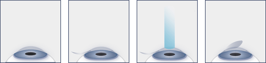 Chart Illustrating the LASIK Eye Surgery Process