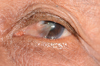 Example of Pterygium